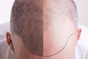 Top view of a men's head with a receding hair line - Before and After