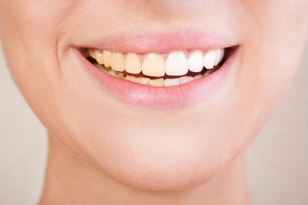 person smiling showing a white set of teeth