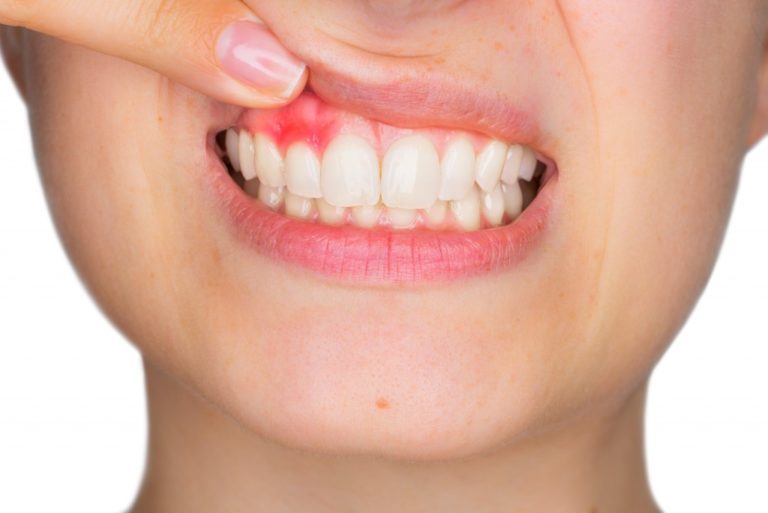 Inflamed upper gums of woman