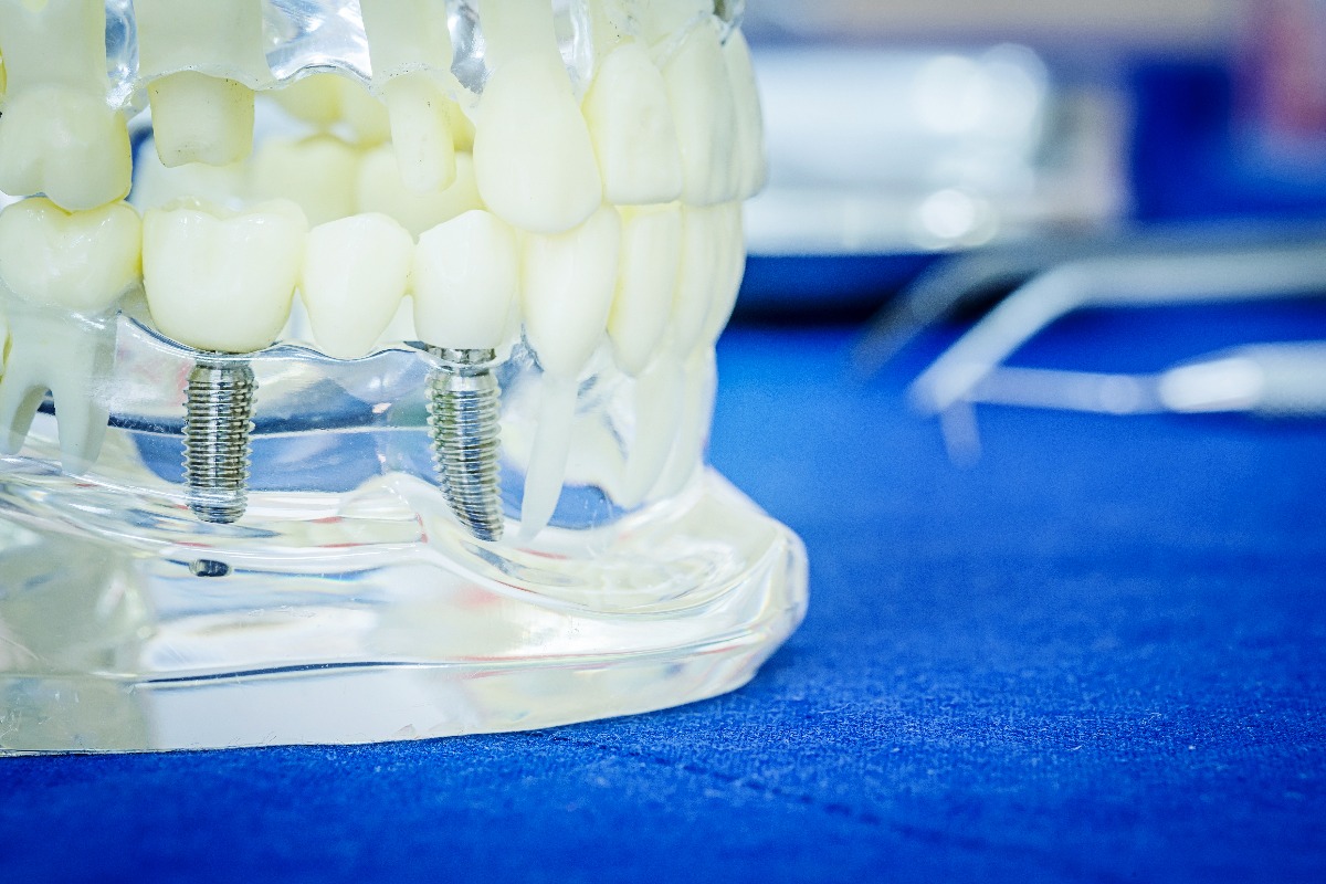 dental implants