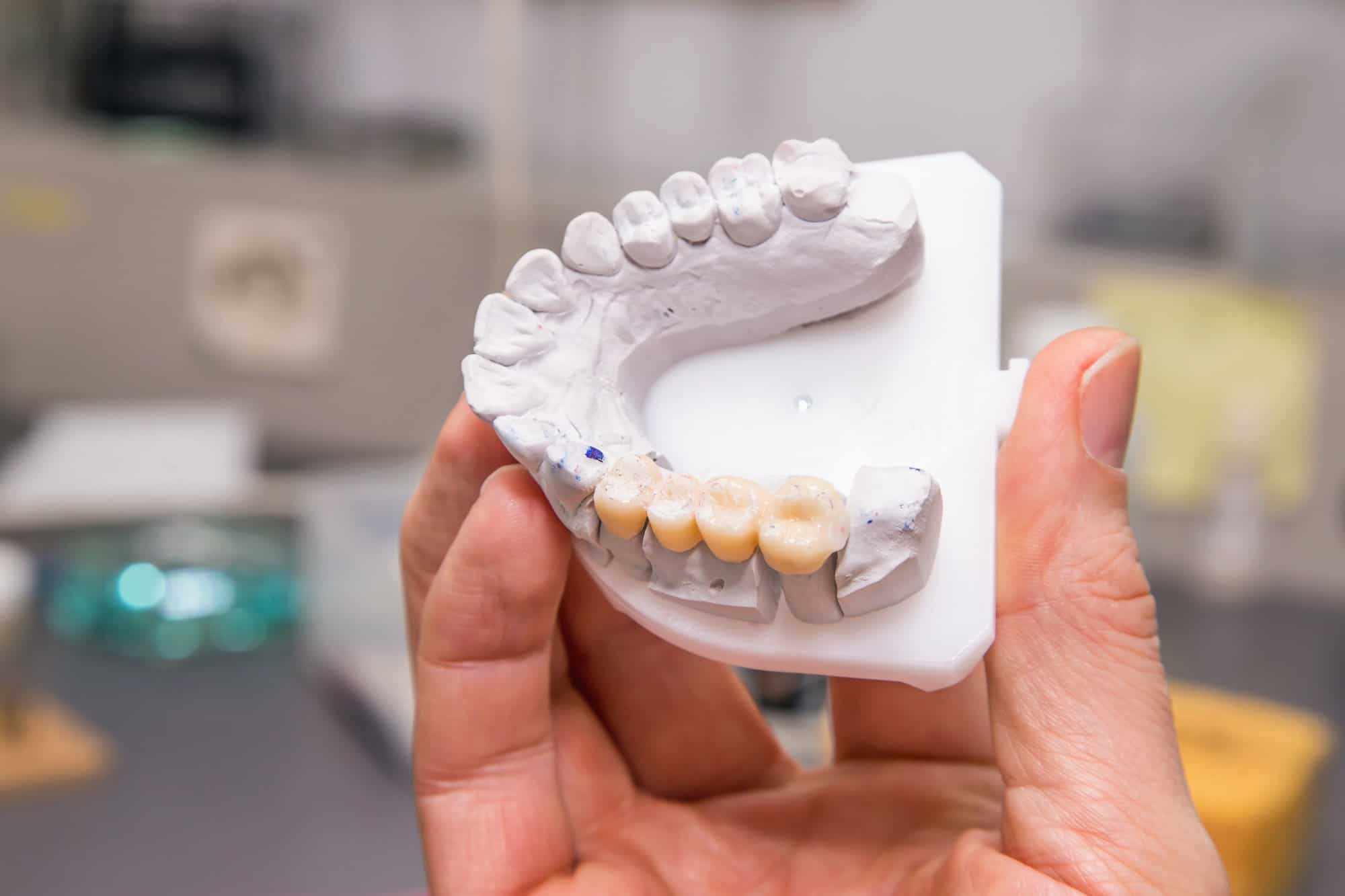 DENTAL IMPLANT