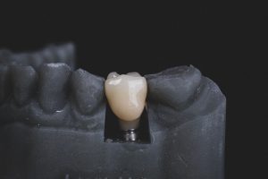 tooth being implanted on carbon model of a mouth