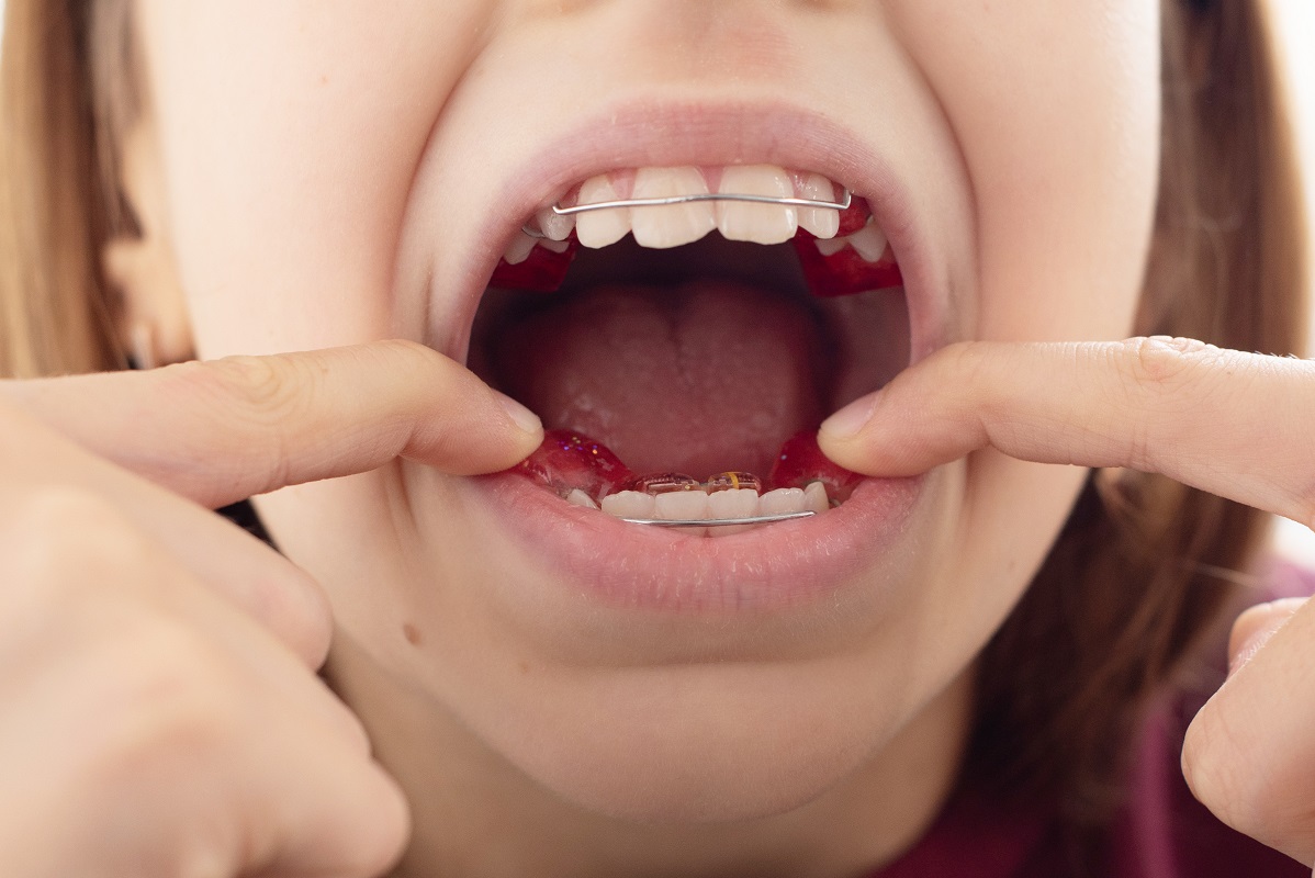 a child with removable orthodontic appliance