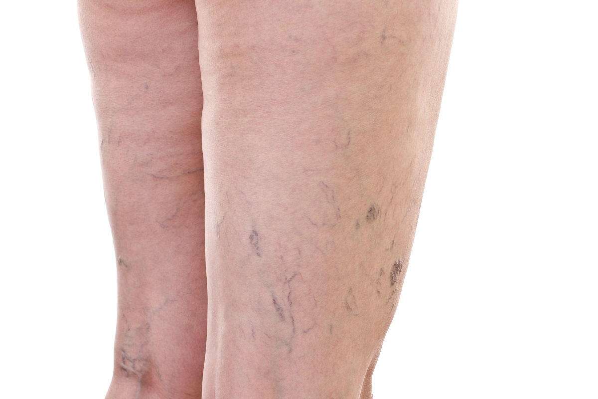 varicose veins